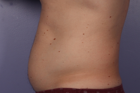 CoolSculpting Before & After Image