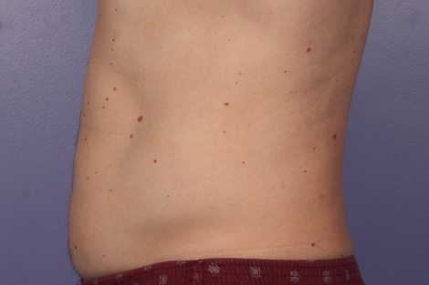 CoolSculpting Before & After Image