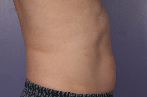 CoolSculpting Before & After Image