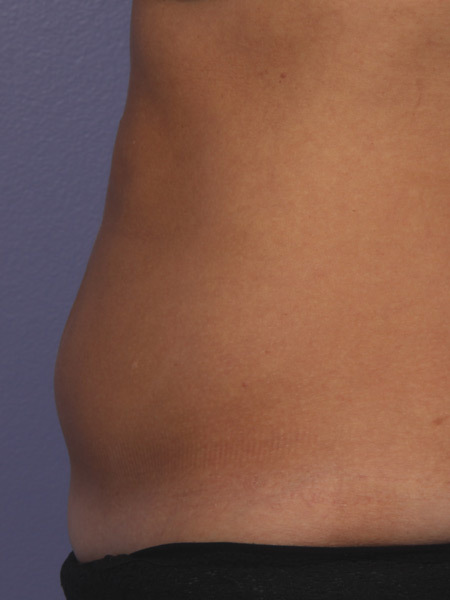 CoolSculpting Before & After Image