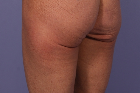 CoolSculpting Before & After Image