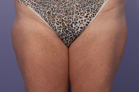 CoolSculpting Before & After Image