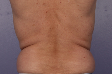 CoolSculpting Before & After Image