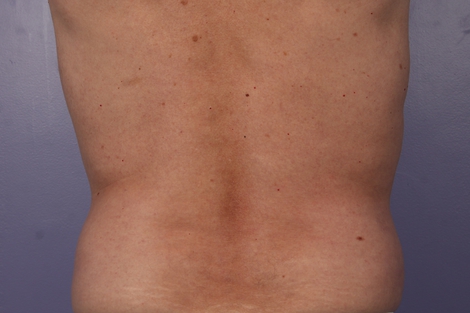 CoolSculpting Before & After Image