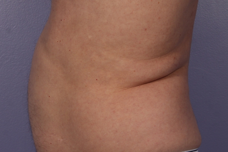 CoolSculpting Before & After Image