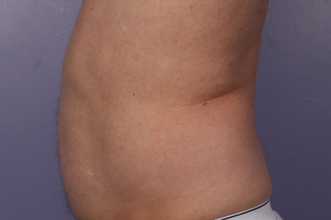 CoolSculpting Before & After Image