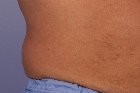 CoolSculpting Before & After Image