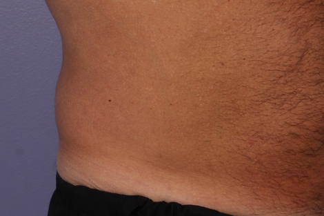 CoolSculpting Before & After Image