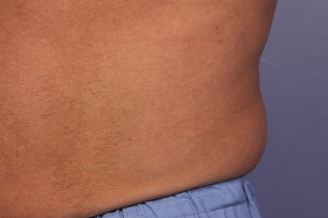 CoolSculpting Before & After Image