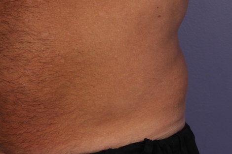 CoolSculpting Before & After Image