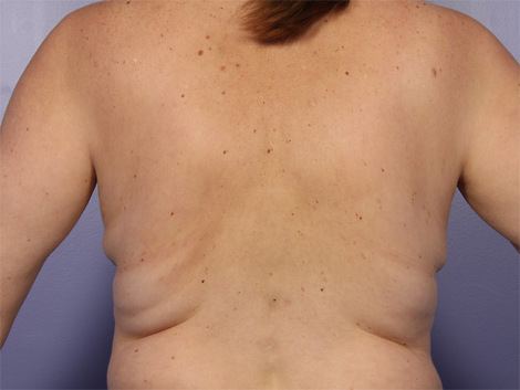 CoolSculpting Before & After Image