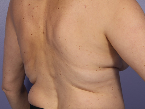 CoolSculpting Before & After Image