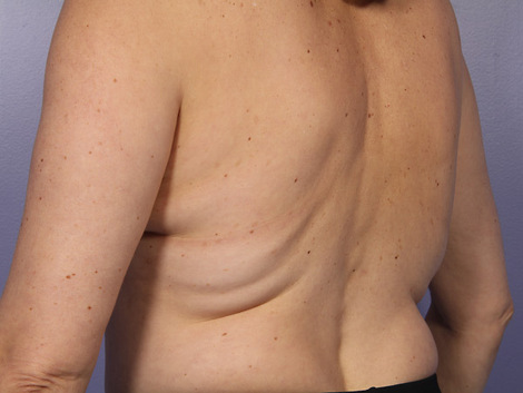 CoolSculpting Before & After Image