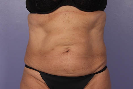 CoolSculpting Before & After Image