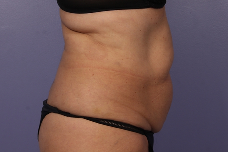 CoolSculpting Before & After Image