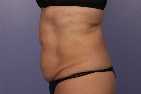 CoolSculpting Before & After Image