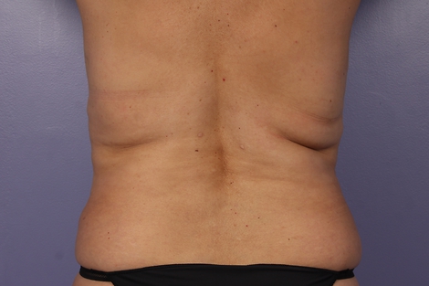 CoolSculpting Before & After Image