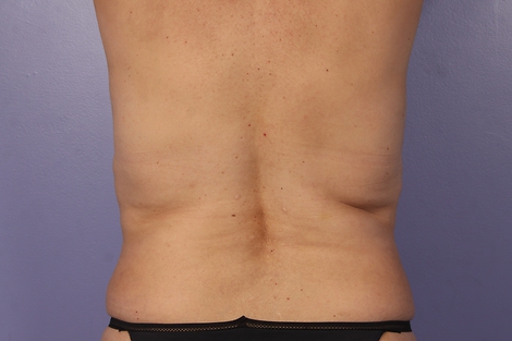 CoolSculpting Before & After Image