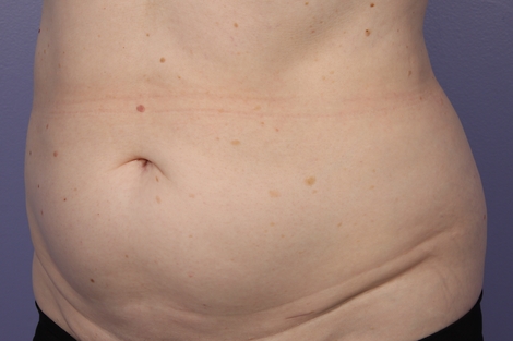 CoolSculpting Before & After Image