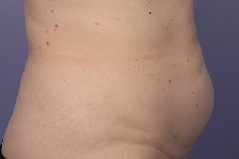 CoolSculpting Before & After Image