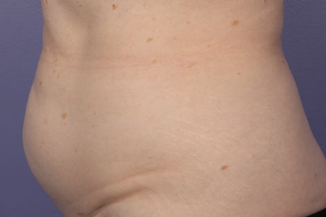 CoolSculpting Before & After Image