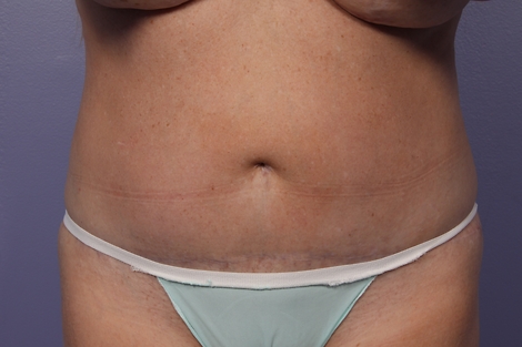 CoolSculpting Before & After Image