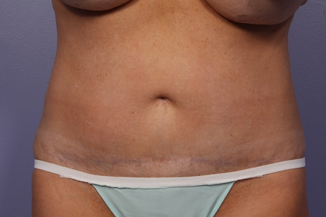 CoolSculpting Before & After Image