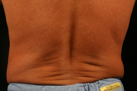 CoolSculpting Before & After Image