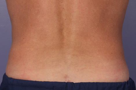 CoolSculpting Before & After Image