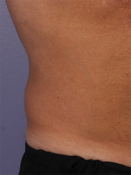 CoolSculpting Before & After Image