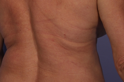 CoolSculpting Before & After Image