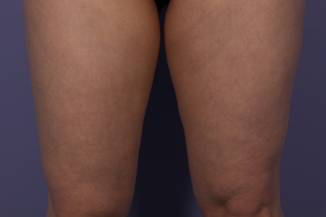 CoolSculpting Before & After Image