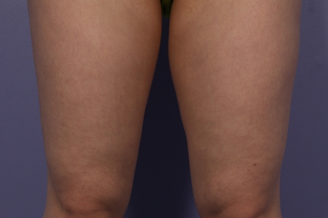 CoolSculpting Before & After Image