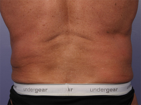 CoolSculpting Before & After Image