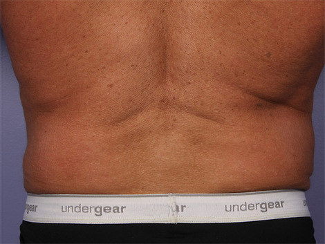 CoolSculpting Before & After Image