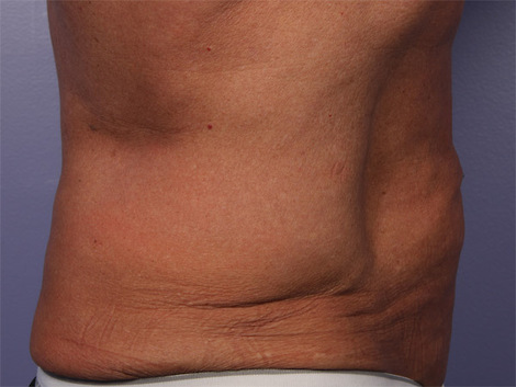 CoolSculpting Before & After Image