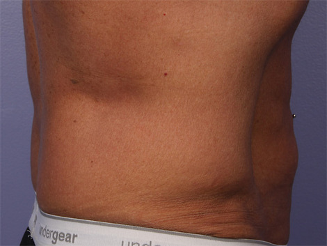 CoolSculpting Before & After Image