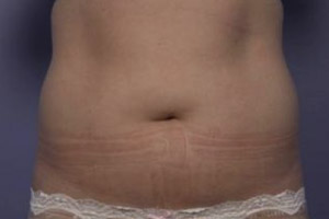 CoolSculpting Before & After Image