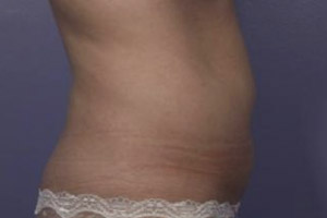 CoolSculpting Before & After Image