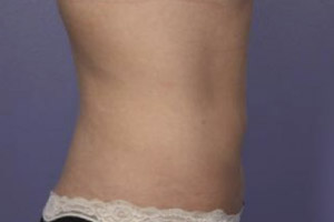 CoolSculpting Before & After Image