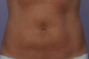 CoolSculpting Before & After Image