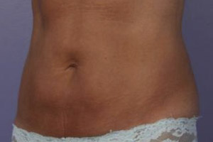 CoolSculpting Before & After Image