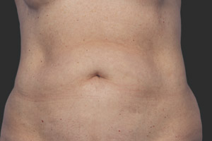 CoolSculpting Before & After Image