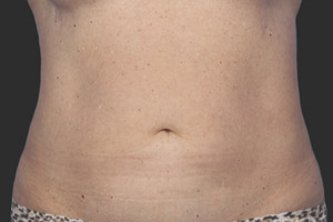 CoolSculpting Before & After Image