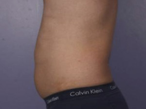 CoolSculpting Before & After Image