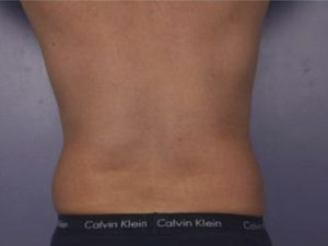 CoolSculpting Before & After Image