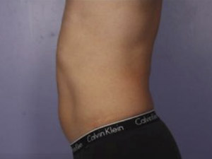 CoolSculpting Before & After Image