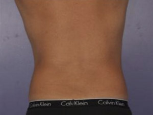 CoolSculpting Before & After Image