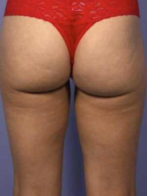 CoolSculpting Before & After Image