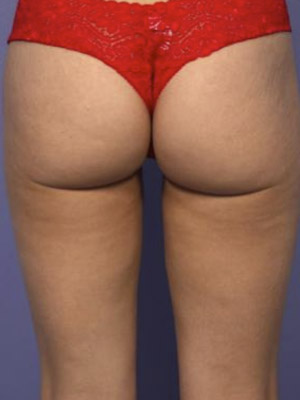 CoolSculpting Before & After Image